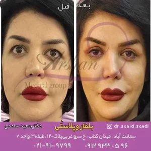کوچک شدن چشم بعد از عمل بلفاروپلاستی
