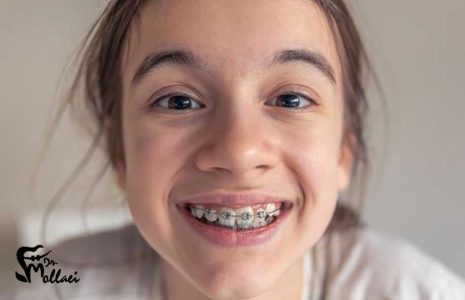 مراحل ارتودنسی دندان کودکان چیست؟