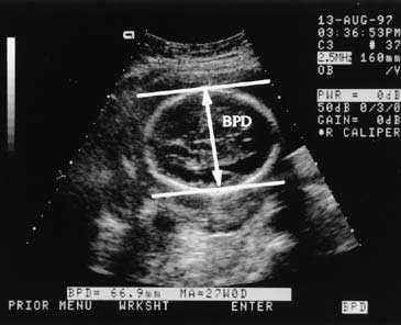 اندازه نرمال bpd جنین در هفته های مختلف بارداری چقدر است؟