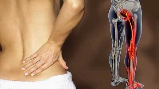 علت درد استخوان لگن تا ساق پا به دلیل فشار بر عصبهای این ناحیه