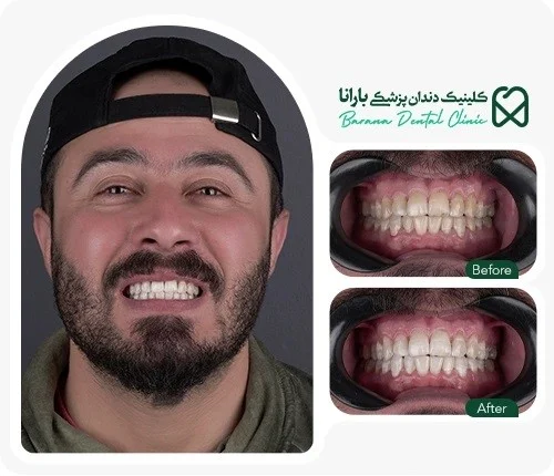 آفیس | چین مراقبت های بعد از هوم بلیچینگ و آفیس بلیچینگ